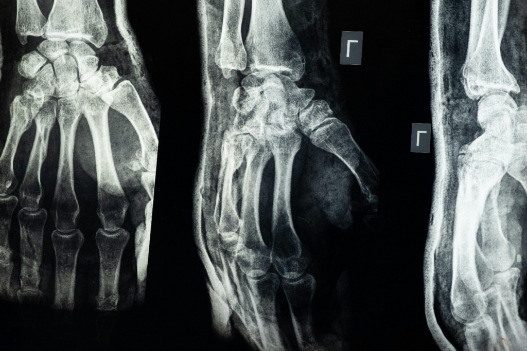 An x-ray of the hand representing how medical imaging can prompt a victim to consider whether they need a personal injury lawyer